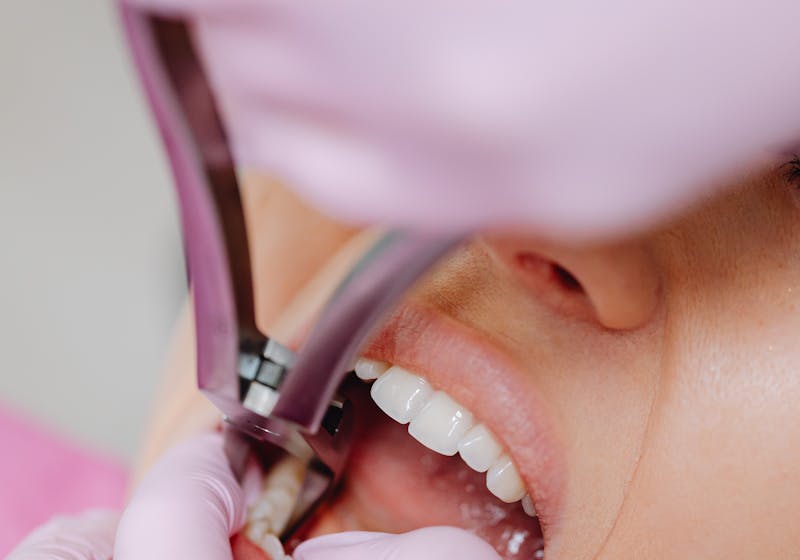 Gentle tooth extraction procedure