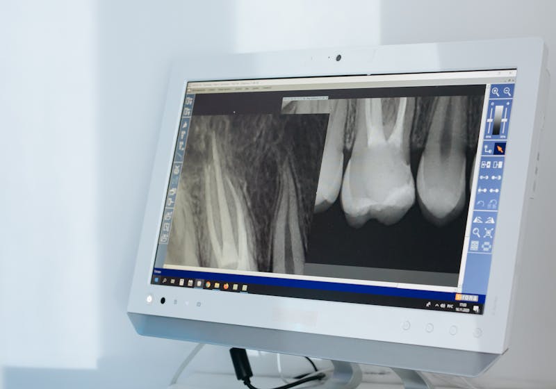 Treatment for a dental abscess and swelling at Limegreen Dental in Hamilton