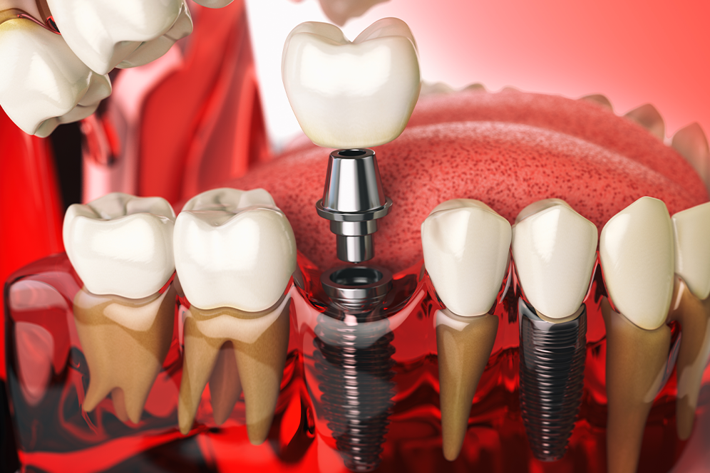 Dental Implants