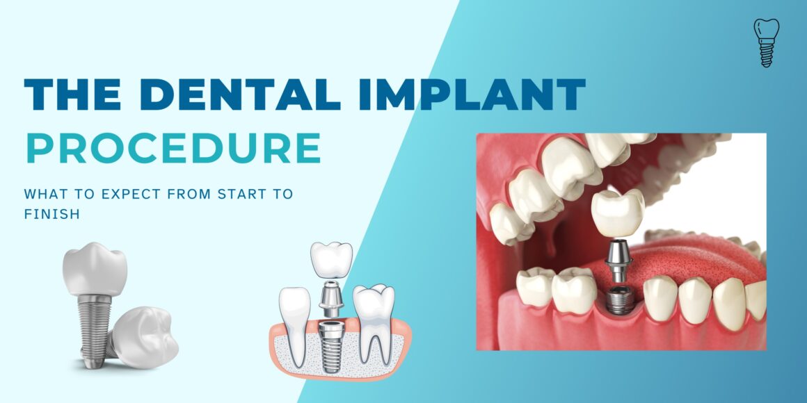 Dental Implant