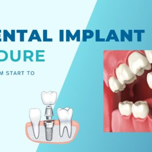 Dental Implant