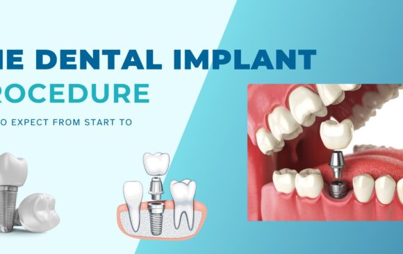 Dental Implant