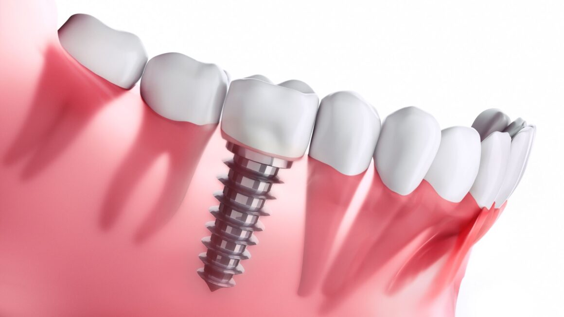 How Dental Implants Improve Your Overall Health